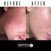 before after retinol serum katie 1